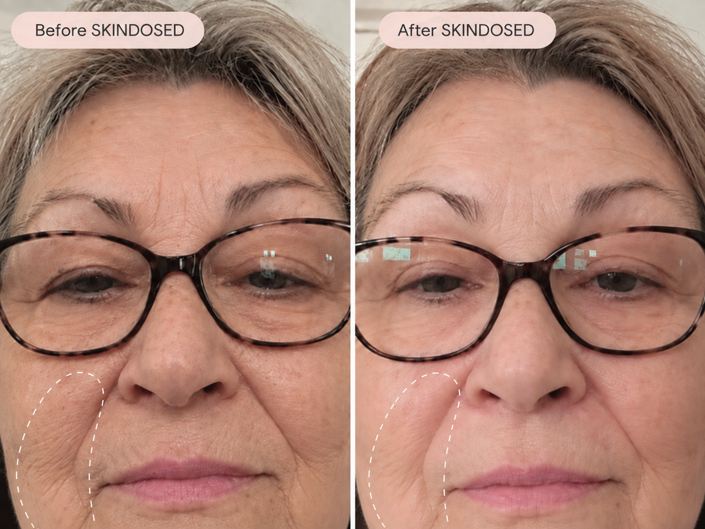 Before and after SkinDosed result showing facial texture