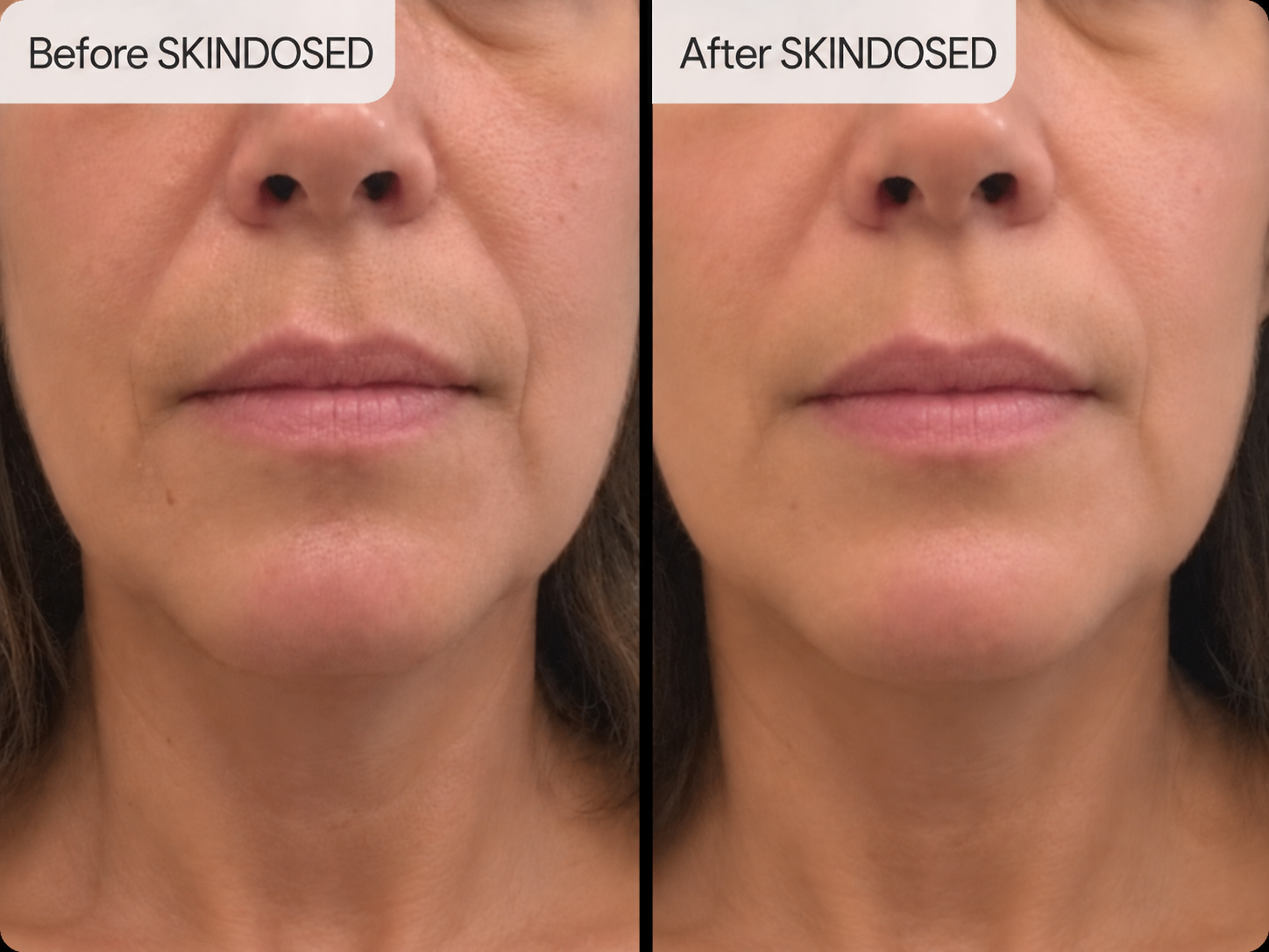 Before and after SkinDosed result showing the mouth and chin